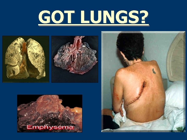 GOT LUNGS? 