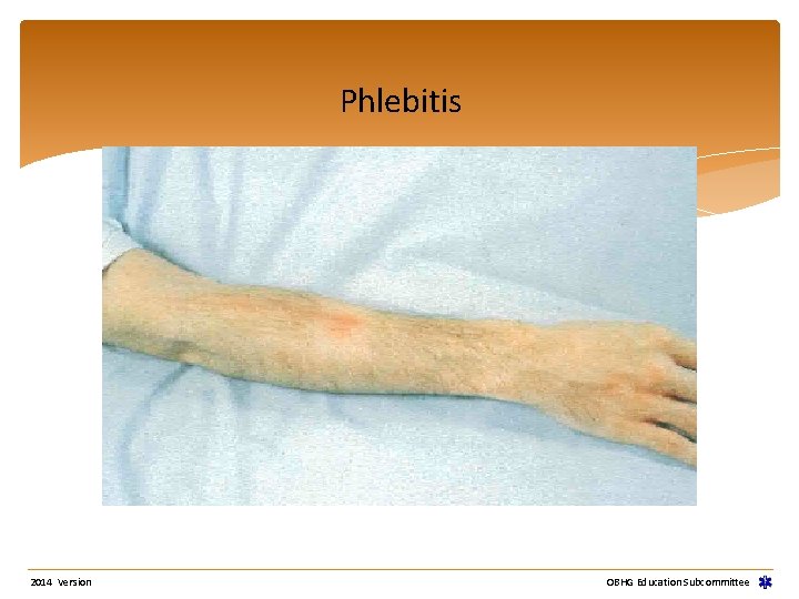 Phlebitis 2014 Version OBHG Education Subcommittee 
