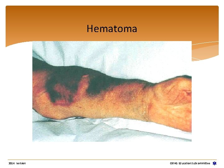 Hematoma 2014 Version OBHG Education Subcommittee 