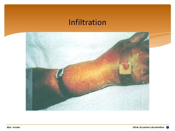 Infiltration 2014 Version OBHG Education Subcommittee 