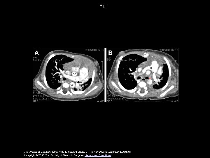 Fig 1 The Annals of Thoracic Surgery 2013 962198 -2202 DOI: (10. 1016/j. athoracsur.