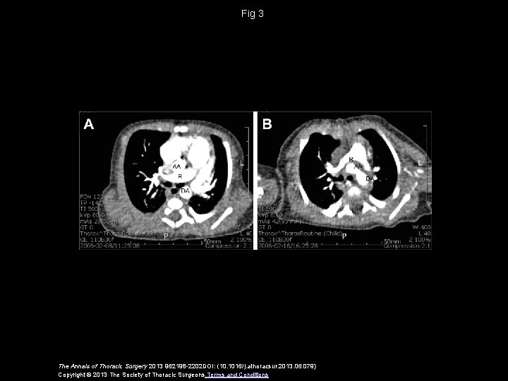 Fig 3 The Annals of Thoracic Surgery 2013 962198 -2202 DOI: (10. 1016/j. athoracsur.