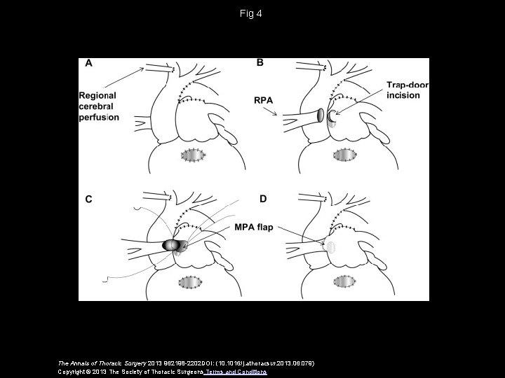 Fig 4 The Annals of Thoracic Surgery 2013 962198 -2202 DOI: (10. 1016/j. athoracsur.
