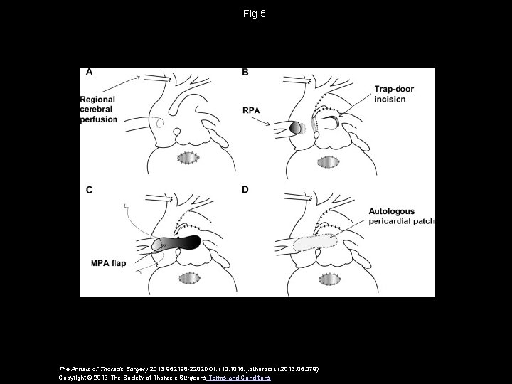 Fig 5 The Annals of Thoracic Surgery 2013 962198 -2202 DOI: (10. 1016/j. athoracsur.