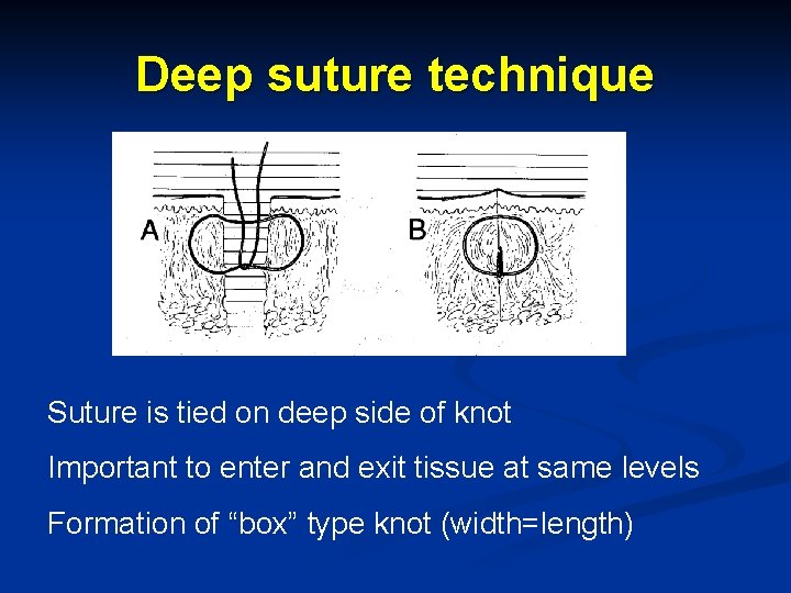 Deep suture technique Suture is tied on deep side of knot Important to enter