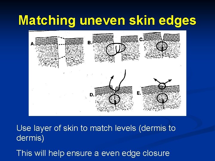 Matching uneven skin edges Use layer of skin to match levels (dermis to dermis)