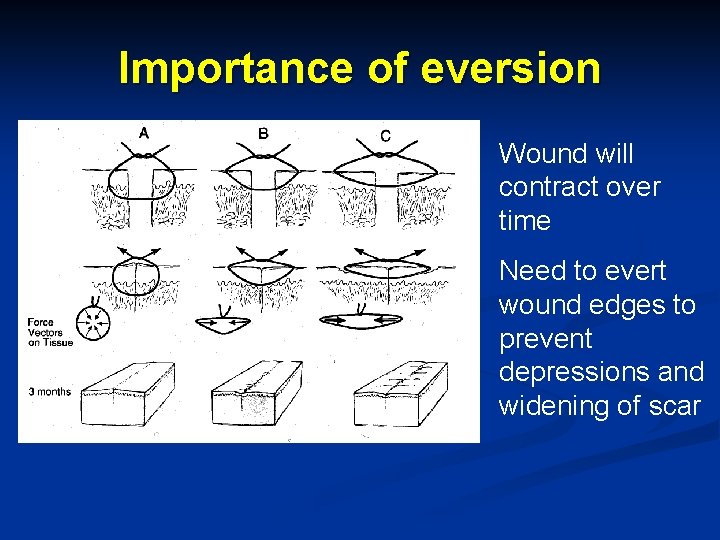 Importance of eversion Wound will contract over time Need to evert wound edges to