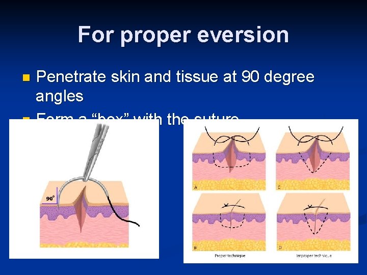 For proper eversion Penetrate skin and tissue at 90 degree angles n Form a