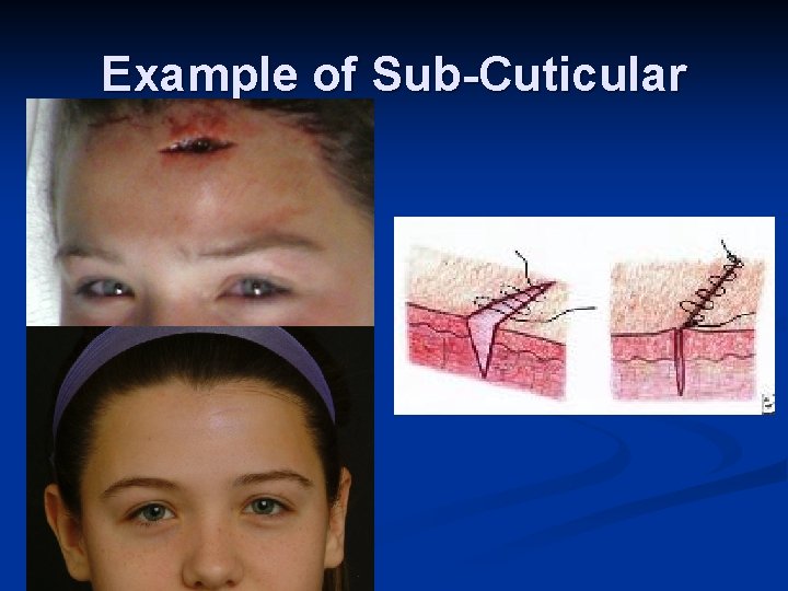 Example of Sub-Cuticular 