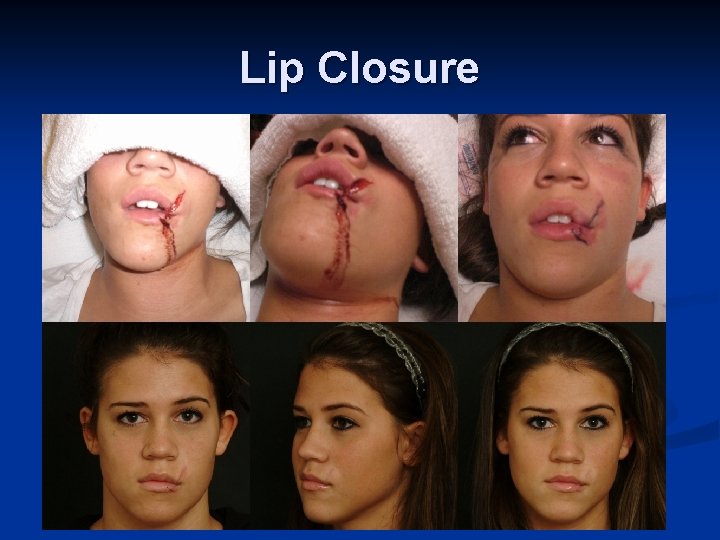 Lip Closure 