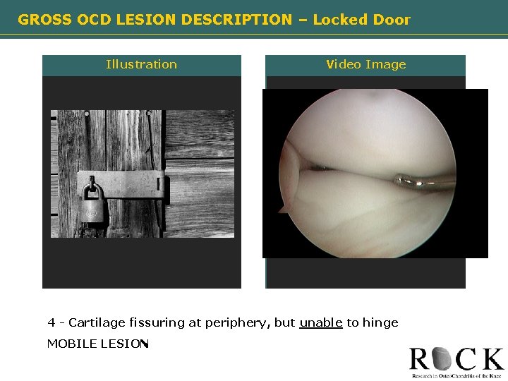 GROSS OCD LESION DESCRIPTION – Locked Door Illustration Need image Video Image Need image