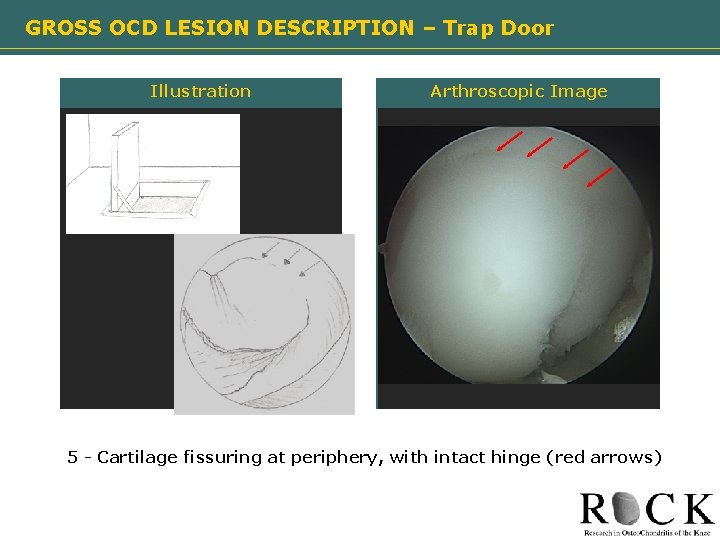 GROSS OCD LESION DESCRIPTION – Trap Door Illustration Arthroscopic Image Need image 5 -