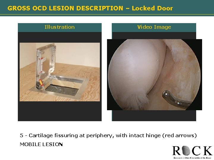 GROSS OCD LESION DESCRIPTION – Locked Door Illustration Need image Video Image Need image