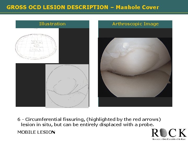 GROSS OCD LESION DESCRIPTION – Manhole Cover Illustration Arthroscopic Image Need image 6 -