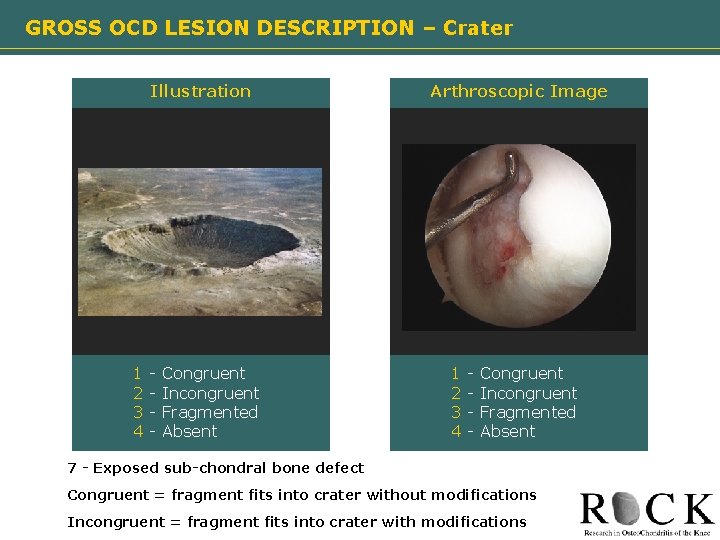 GROSS OCD LESION DESCRIPTION – Crater Illustration Arthroscopic Image Need image 1 2 3