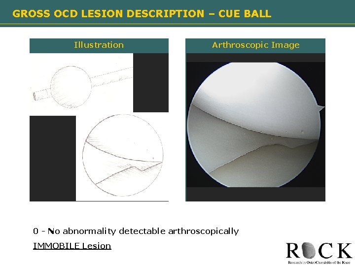 GROSS OCD LESION DESCRIPTION – CUE BALL Illustration Arthroscopic Image Need image 0 -