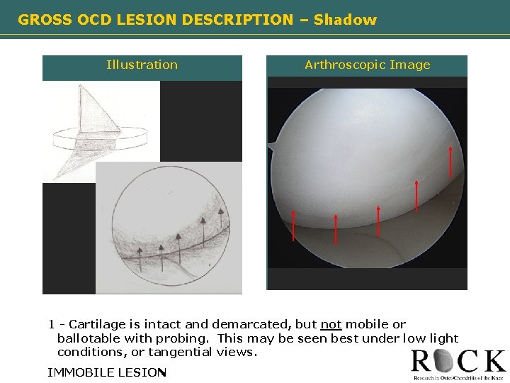 GROSS OCD LESION DESCRIPTION – Shadow Illustration Need image Arthroscopic Image Need image 1