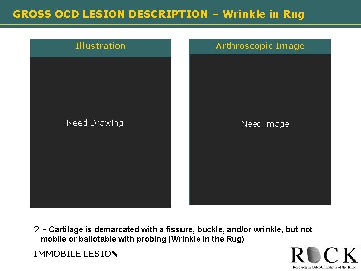 GROSS OCD LESION DESCRIPTION – Wrinkle in Rug Illustration Need Drawing image Arthroscopic Image