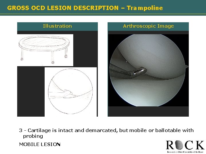 GROSS OCD LESION DESCRIPTION – Trampoline Illustration Arthroscopic Image Need image 3 - Cartilage