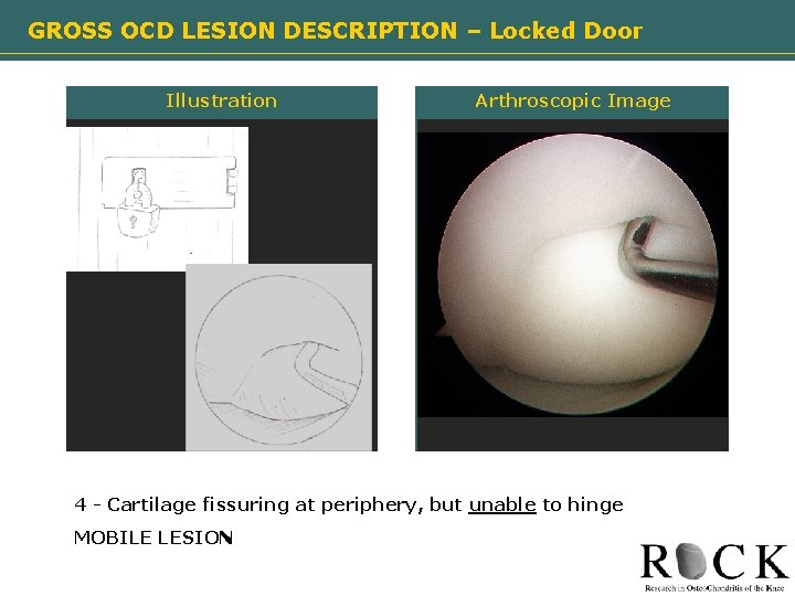 GROSS OCD LESION DESCRIPTION – Locked Door Illustration Arthroscopic Image Need image 4 -