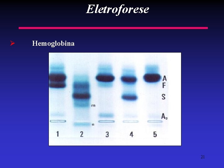 Eletroforese Ø Hemoglobina - Hemoglobina anormais - Carga elétrica - Ponto isoelétrico - Hemoglobina