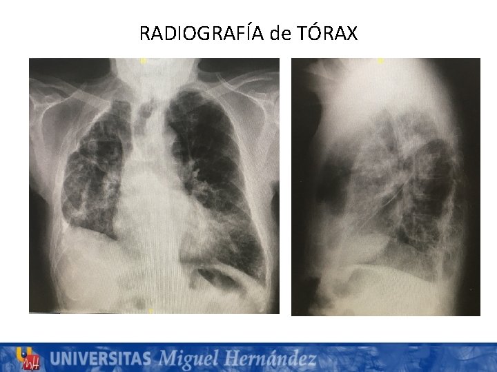 RADIOGRAFÍA de TÓRAX 