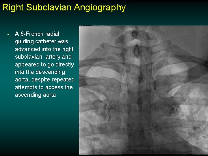 Right Subclavian Angiography • A 6 -French radial guiding catheter was advanced into the