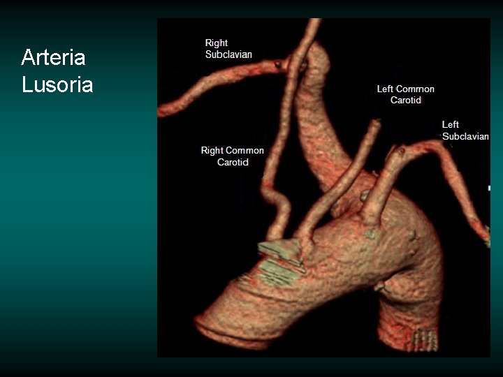 Arteria Lusoria 