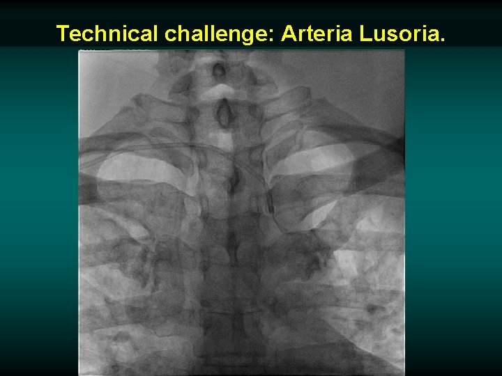 Technical challenge: Arteria Lusoria. 