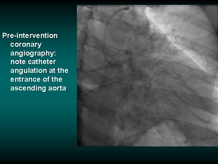 Pre-intervention coronary angiography: note catheter angulation at the entrance of the ascending aorta 