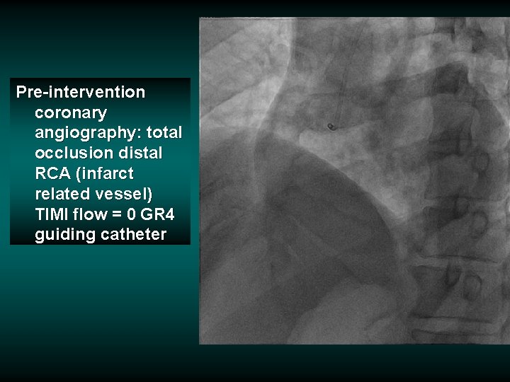 Pre-intervention coronary angiography: total occlusion distal RCA (infarct related vessel) TIMI flow = 0