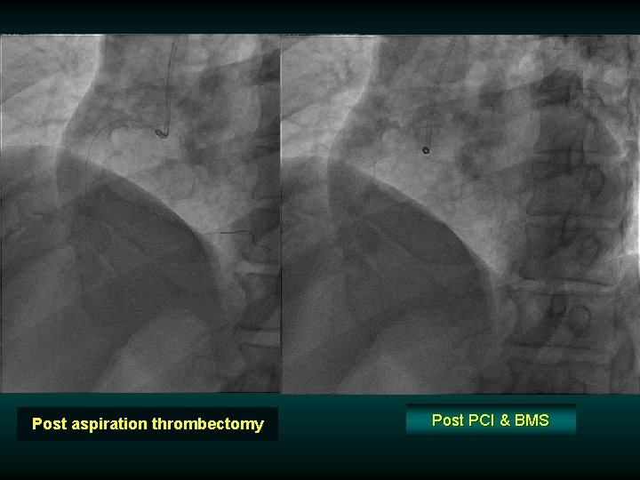 Post aspiration thrombectomy Post PCI & BMS 