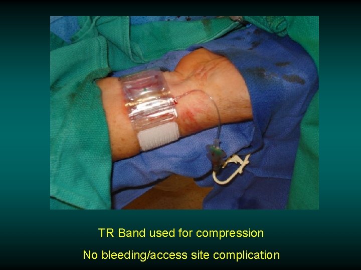 TR Band used for compression No bleeding/access site complication 