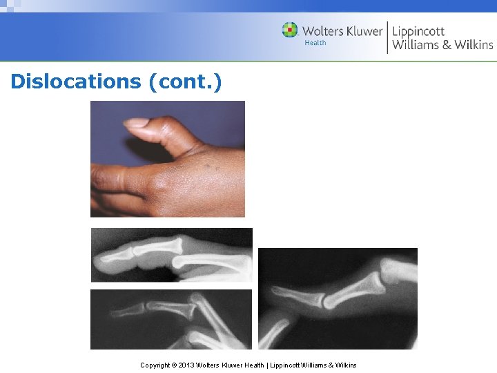Dislocations (cont. ) Copyright © 2013 Wolters Kluwer Health | Lippincott Williams & Wilkins