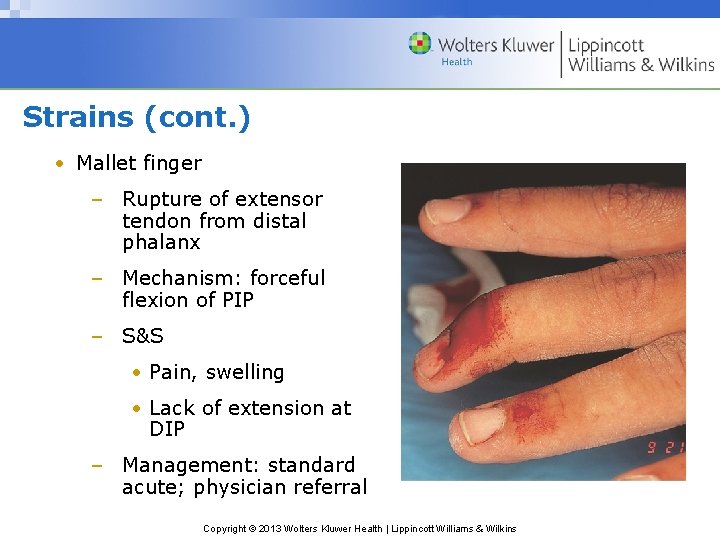 Strains (cont. ) • Mallet finger – Rupture of extensor tendon from distal phalanx