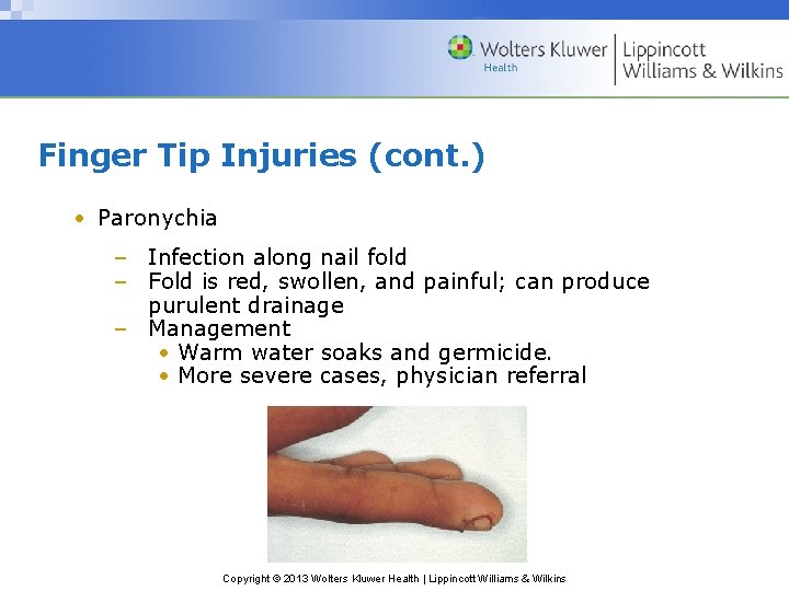 Finger Tip Injuries (cont. ) • Paronychia – Infection along nail fold – Fold