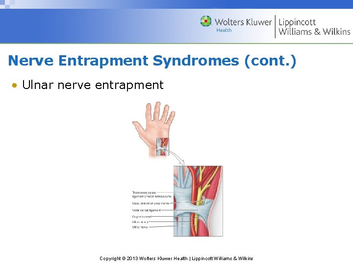 Nerve Entrapment Syndromes (cont. ) • Ulnar nerve entrapment Copyright © 2013 Wolters Kluwer