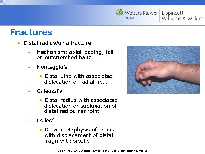 Fractures • Distal radius/ulna fracture – Mechanism: axial loading; fall on outstretched hand –
