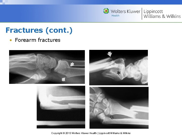 Fractures (cont. ) • Forearm fractures Copyright © 2013 Wolters Kluwer Health | Lippincott