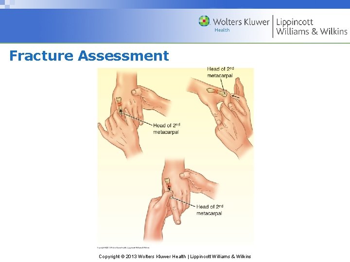 Fracture Assessment Copyright © 2013 Wolters Kluwer Health | Lippincott Williams & Wilkins 