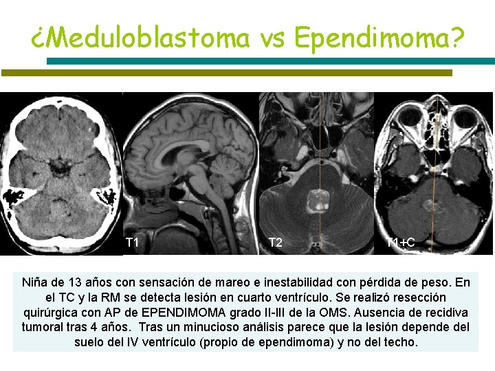 ¿Meduloblastoma vs Ependimoma? T 1 T 2 T 1+C Niña de 13 años con