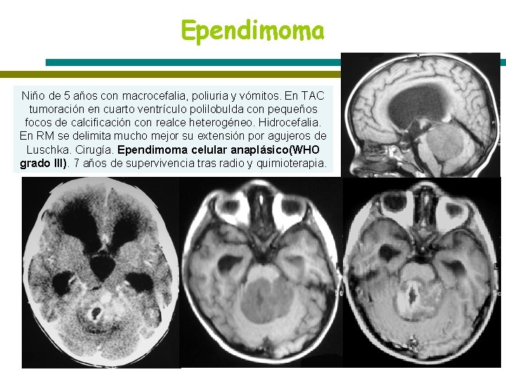 Ependimoma Niño de 5 años con macrocefalia, poliuria y vómitos. En TAC tumoración en