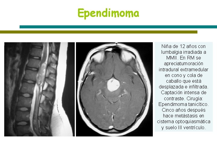 Ependimoma Niña de 12 años con lumbalgia irradiada a MMII. En RM se apreciatumoración