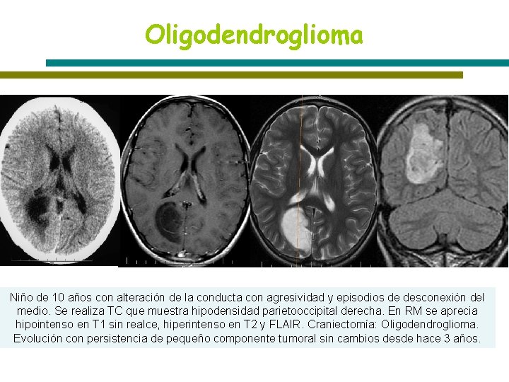 Oligodendroglioma Niño de 10 años con alteración de la conducta con agresividad y episodios