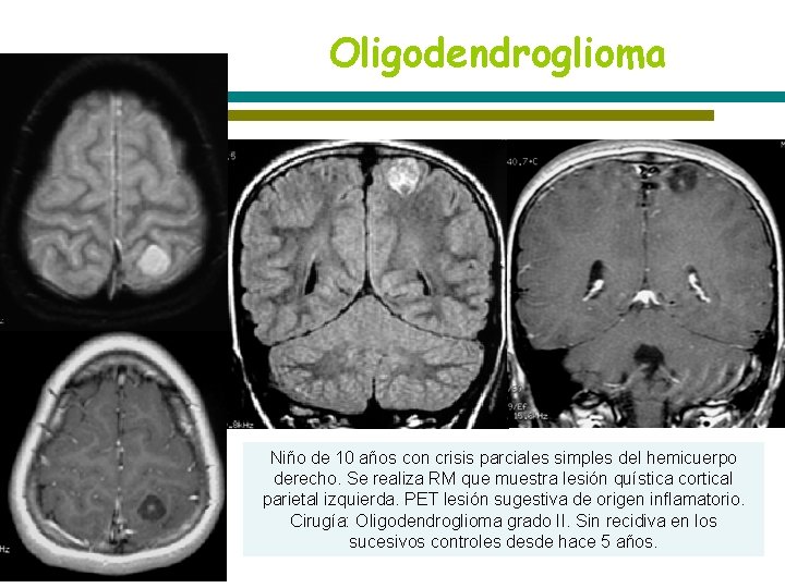 Oligodendroglioma Niño de 10 años con crisis parciales simples del hemicuerpo derecho. Se realiza