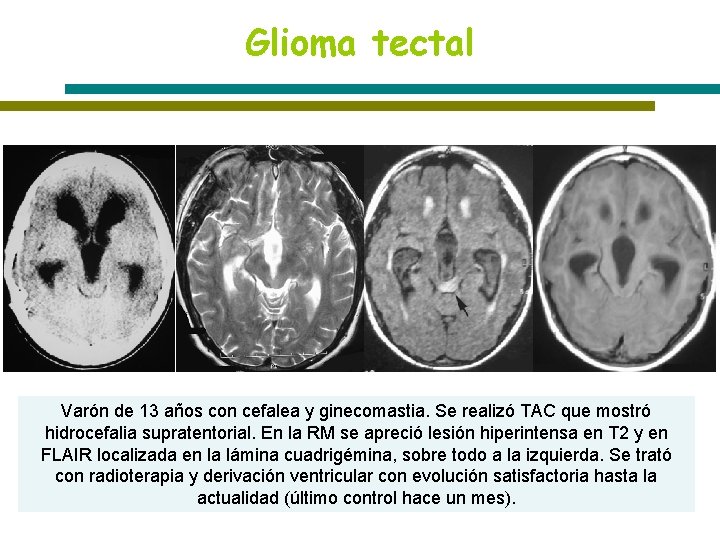 Glioma tectal Varón de 13 años con cefalea y ginecomastia. Se realizó TAC que