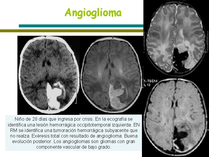 Angioglioma Niño de 28 días que ingresa por crisis. En la ecografía se identifica