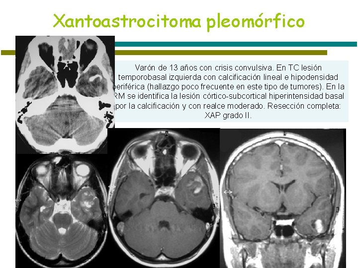 Xantoastrocitoma pleomórfico Varón de 13 años con crisis convulsiva. En TC lesión temporobasal izquierda