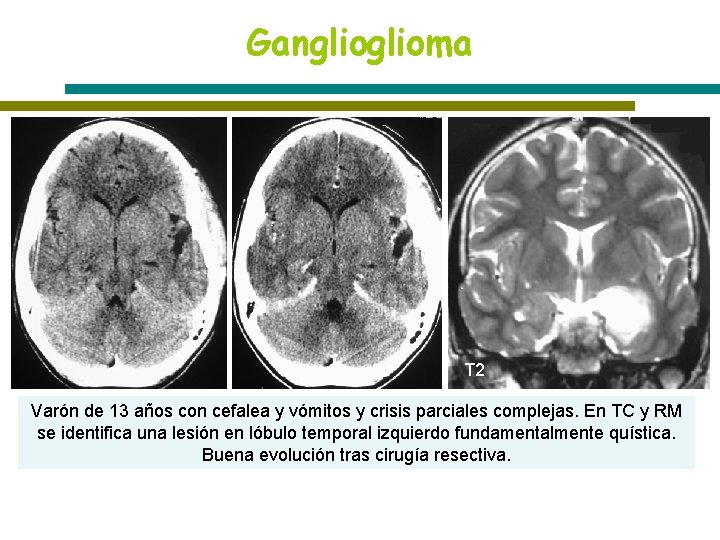 Ganglioma T 2 Varón de 13 años con cefalea y vómitos y crisis parciales