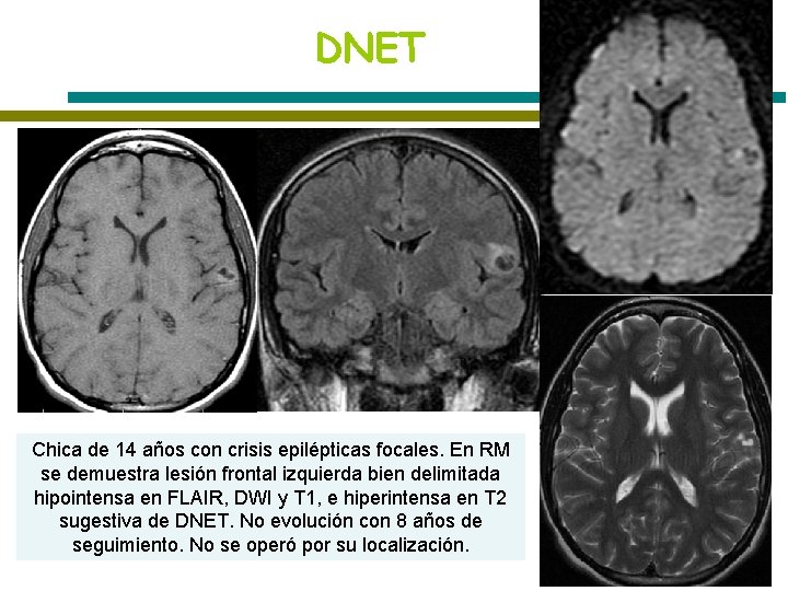 DNET T 2 Chica de 14 años con crisis epilépticas focales. En RM se